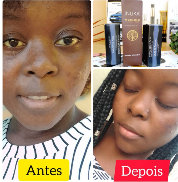 óleos milagrosos Que fazem milagre a pele #oleos para cara #naturecosmeticos #tratamento de acne