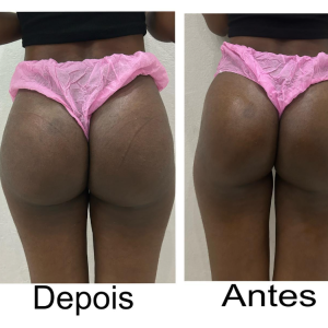 Bumbum na nuca procedimento para empinar , firmar e remodelar o bumbum Beira Tpb de Matacuane na antiga farmácia