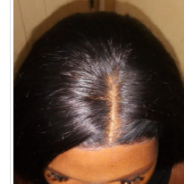 Aplicacao e personalizacao de protese