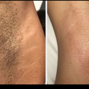 Depilação das axilas