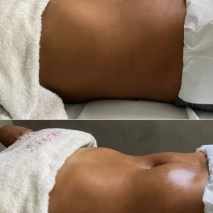 Secções combinas de massagem redução, lipocavitação, lipolaser